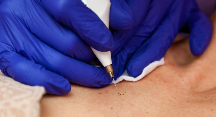 Electrocautery – Skin Tag, Wart & Corn Removal